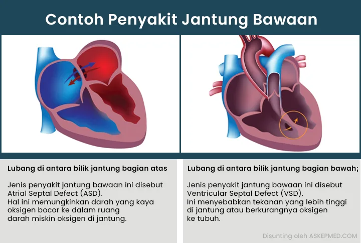 Contong penyakit jantung bawaan pada anak